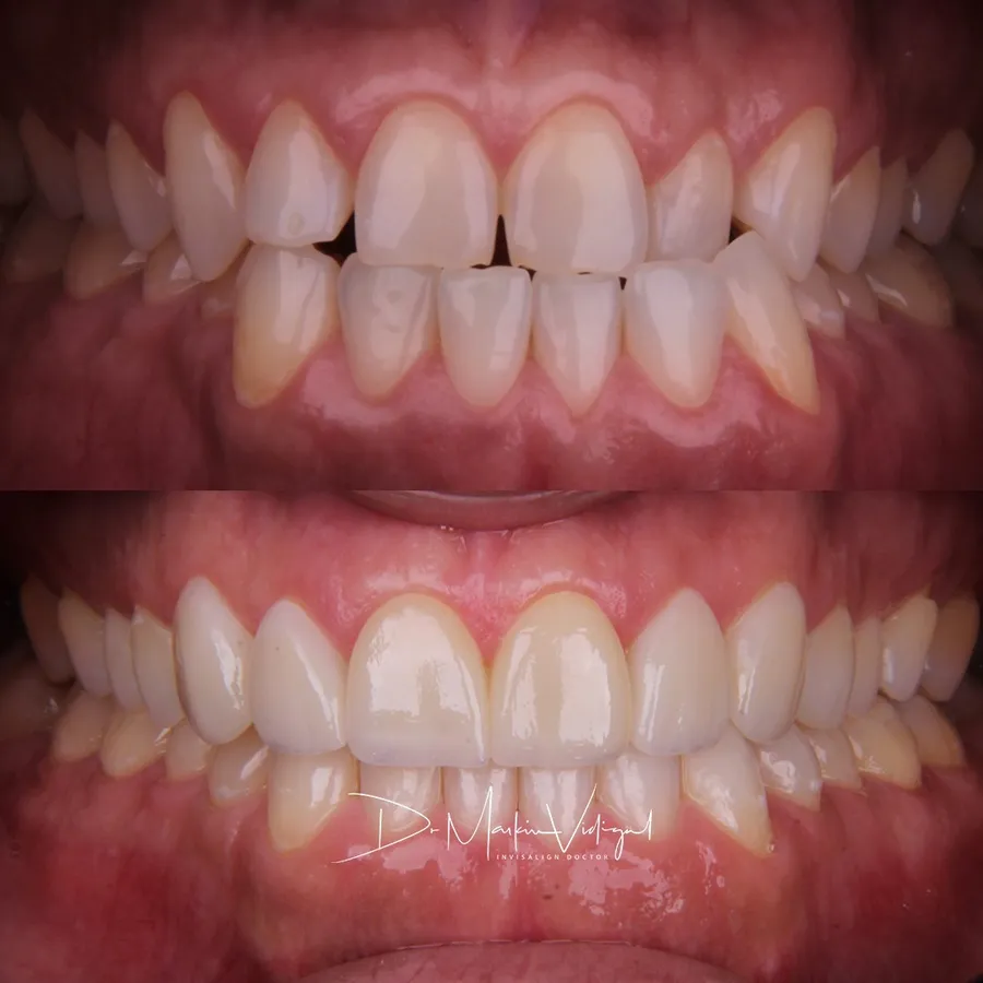 Antes e depois de Invisalign: dentes da frente com espaços e desalinhamento, depois alinhados e fechados