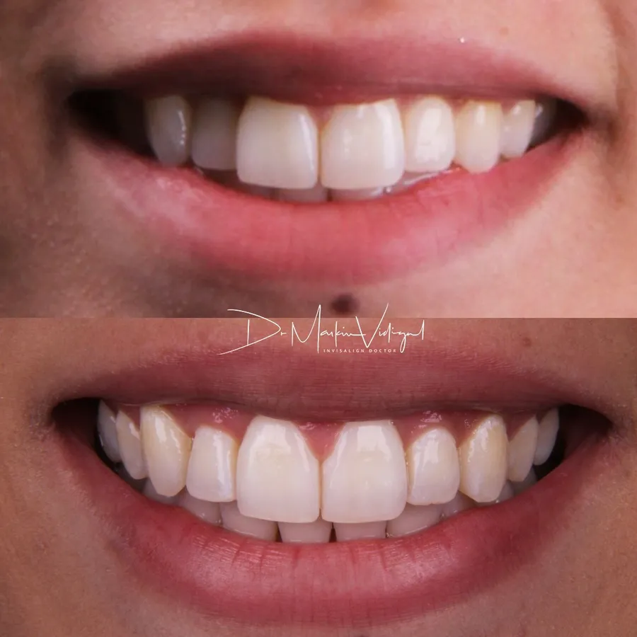 Antes e depois de Invisalign: sorriso com dentes desalinhados, depois sorriso alinhado