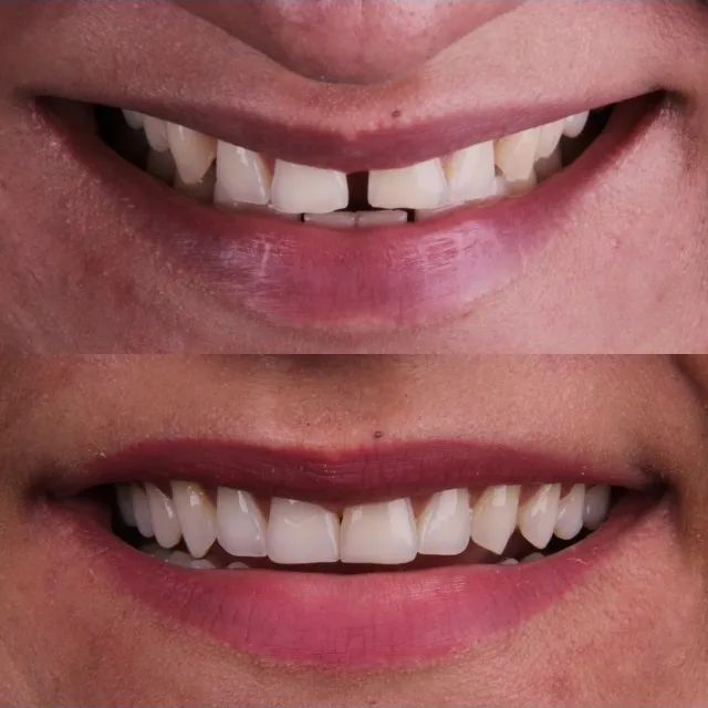 Antes e depois de Invisalign em um ano e dois meses de tratamento