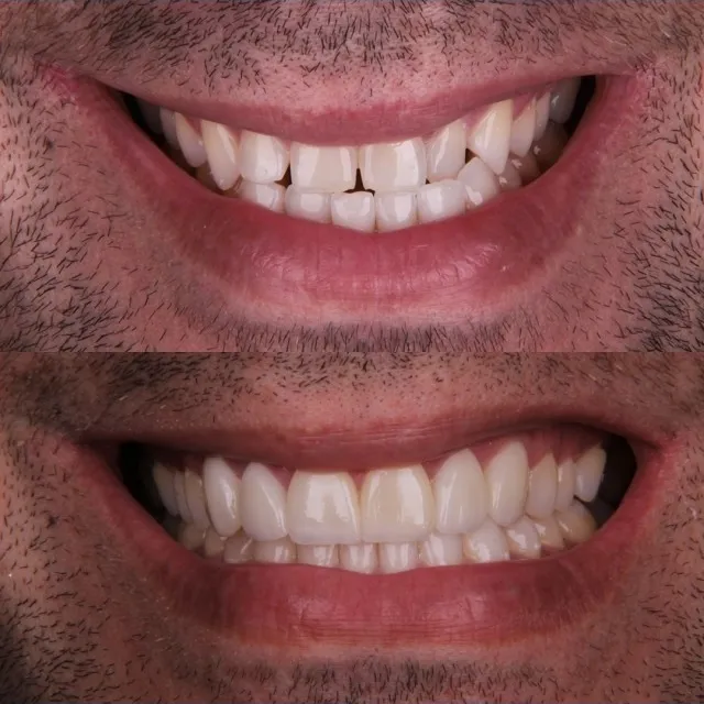 Antes e depois de Invisalign em caso de mordida cruzada