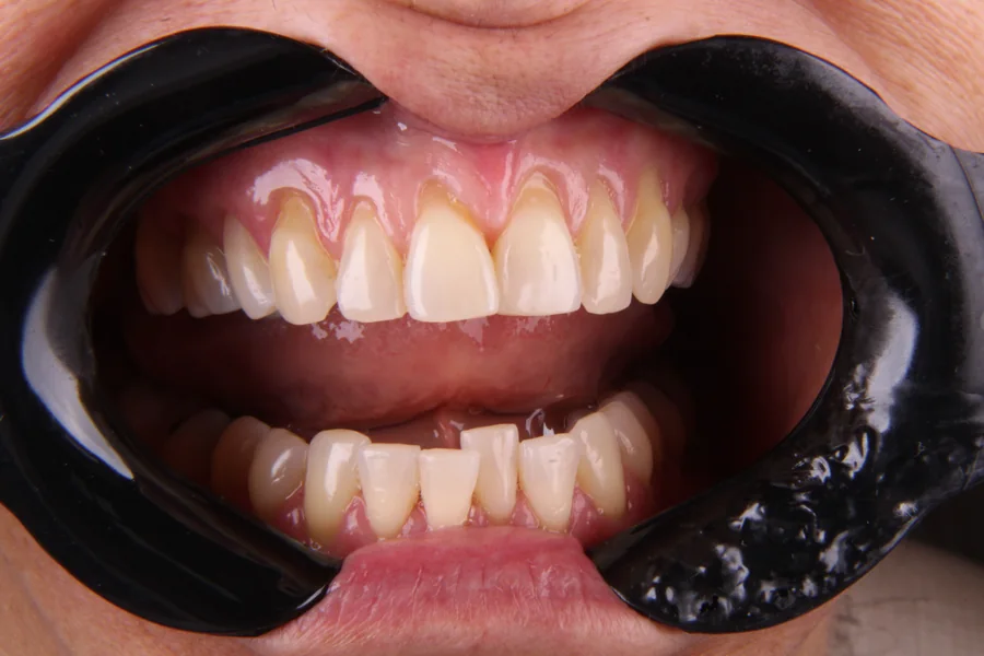 Antes: dentes de baixo apinhados