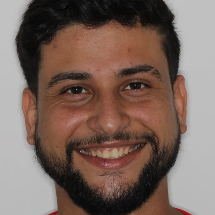 Antes: Mateus sorrindo, com dentes amarelados e de tamanhos diferentes