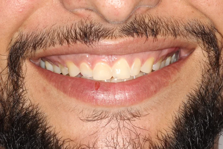Antes: sorriso de perto, com dentes amarelados e bordas irregulares