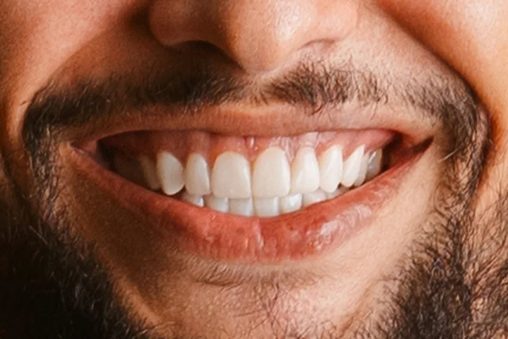 Sorriso de perto depois das facetas em resina