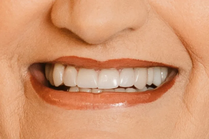 Depois: sorriso de perto, com as facetas deixando os dentes da frente iguais em cor e formato