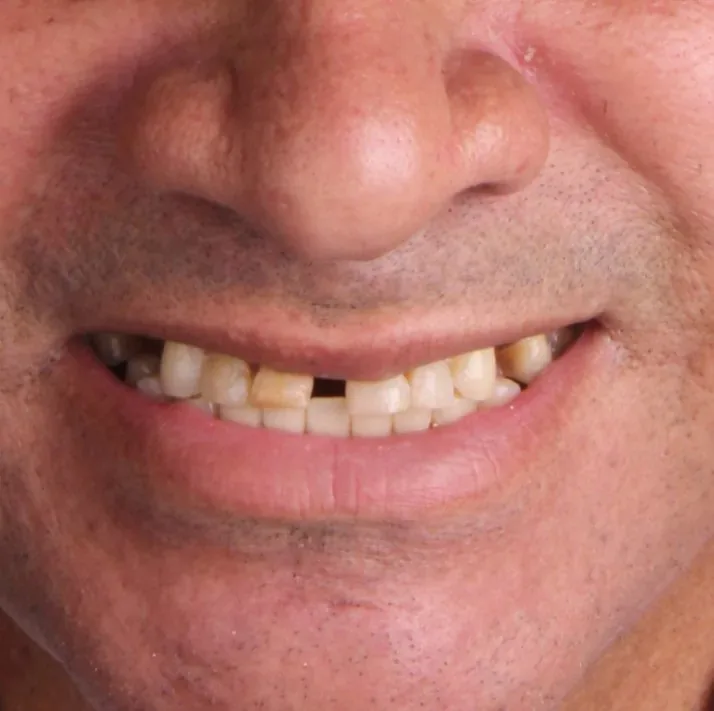 Antes: sorriso com dentes desgastados e ausentes