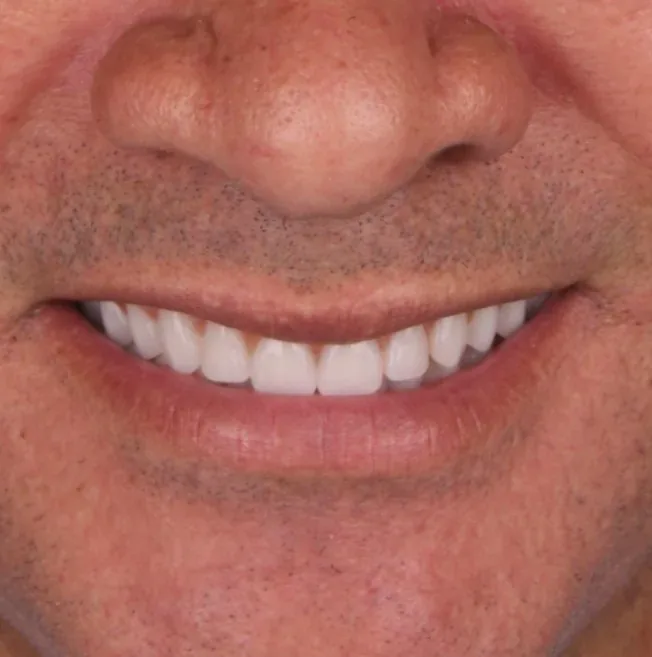 Sorriso completo com prótese protocolo fixa sobre implantes